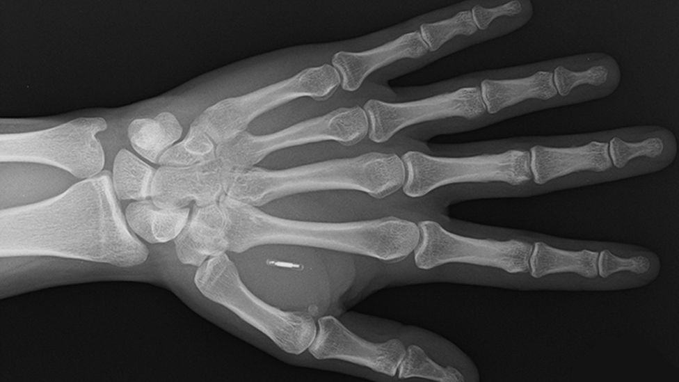 the microchip implants that let you pay with your hand 01